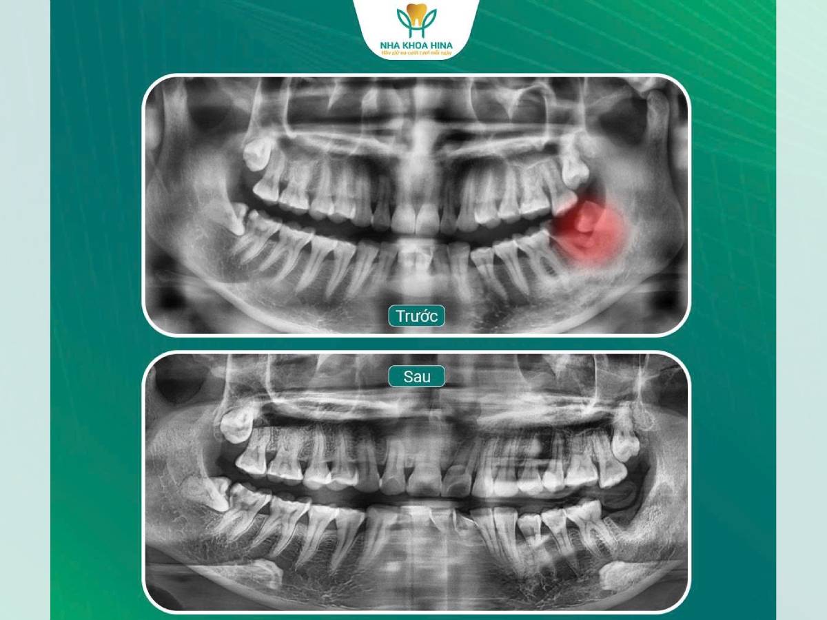 Răng khôn số R47, R48