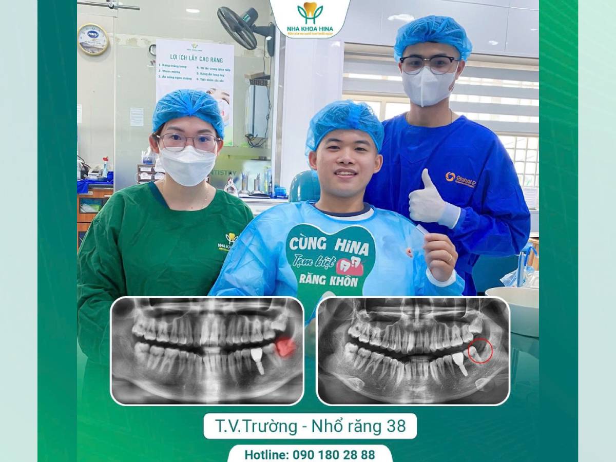 Nhổ răng khôn số 38