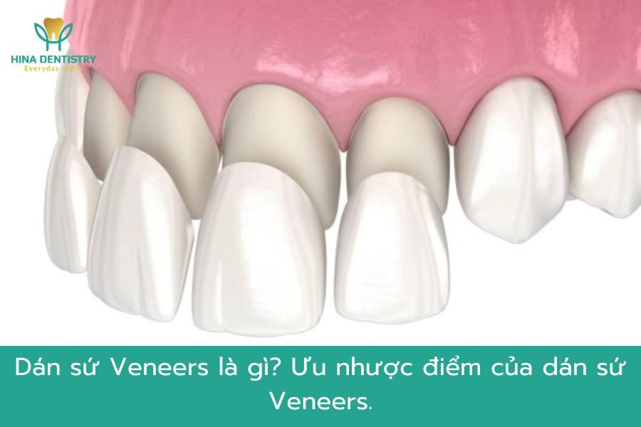Dán sứ Veneer là gì? Ưu nhược điểm của dán sứ Veneer
