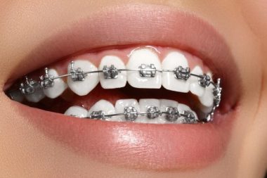  Lấy lại nụ cưới nhờ niềng răng 