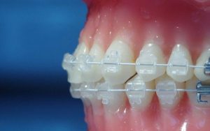 Niềng răng mắc cài sứ thẩm mỹ