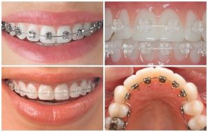 Niềng răng mắc cài 