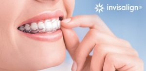 Niềng răng với máng trong suốt Invisalign 