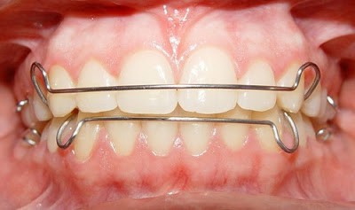 Tiền chỉnh nha với khí cụ tháo lắp 
