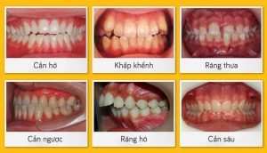 Những ca lâm sàng cần nhổ răng đóng khoảng