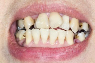 Trước gắn mắc cài