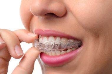  Tháo niềng và đeo hàm duy trì 