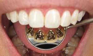 Bệnh nhân đeo duy trì mặt trong 