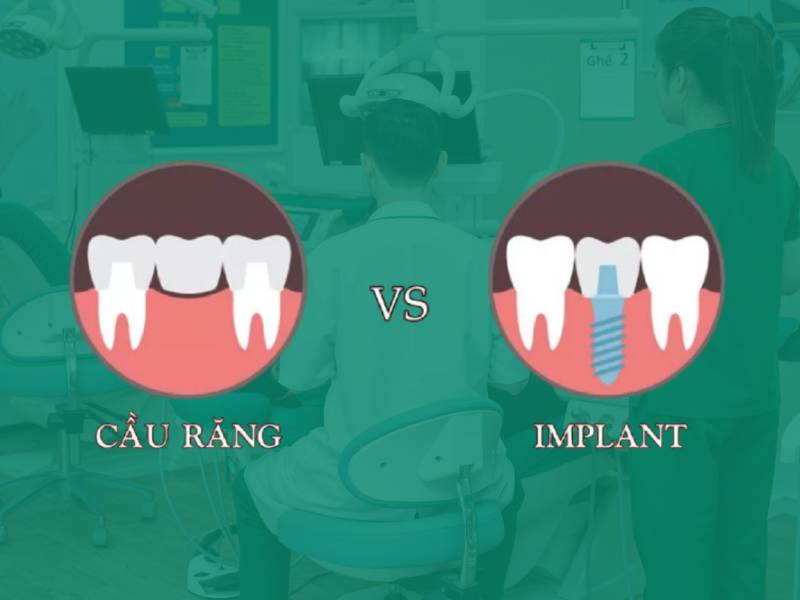 So sánh giữa trồng răng implant và cầu răng