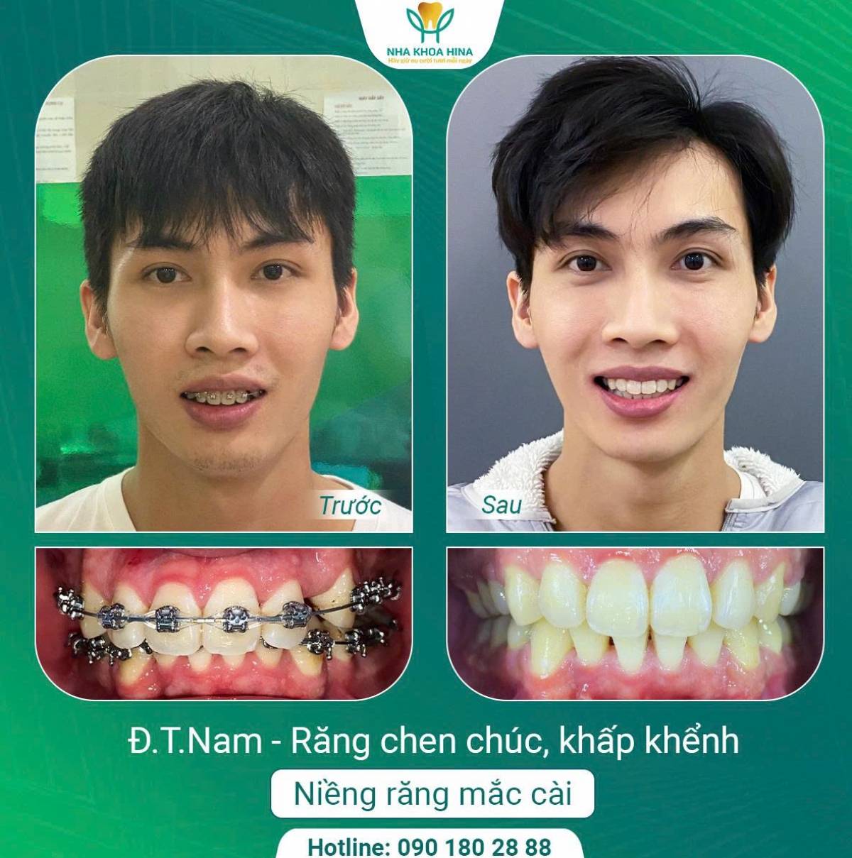 Niềng Răng – Giải Pháp Hoàn Hảo Cho Nụ Cười Tự Tin Và Sức Khỏe Răng Miệng