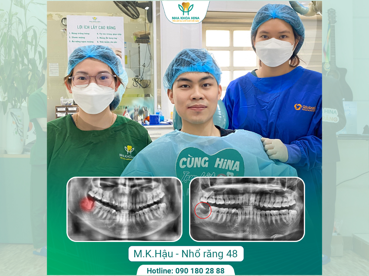 Chia Tay Răng Khôn – Bảo Vệ Răng Số 7 Tránh Nguy Cơ Hư Hại