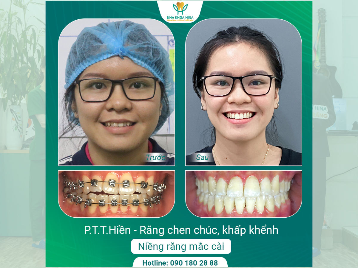 Niềng Răng – Tạm Biệt Tự Ti, Tự Tin Nụ Cười Rạng Rỡ