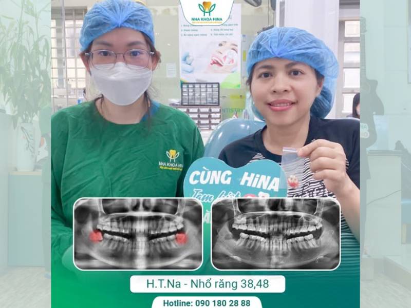 Đau Răng Khôn Bao Lâu Thì Hết? Có Cần Nhổ Không?