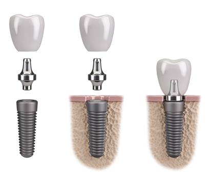 Implant Osstem (Hàn Quốc)