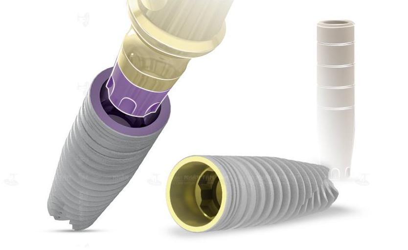 Implant MIS (Israel)