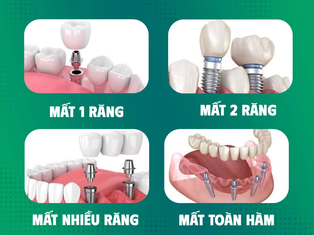 Các trường hợp cần cấy ghép Implant