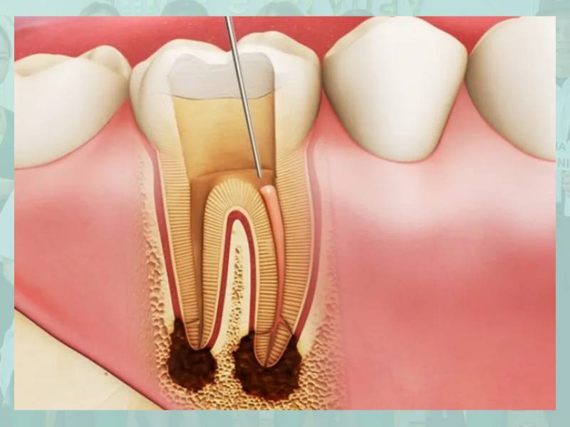 Viêm tuỷ răng - Biến chứng từ răng sâu không điều trị