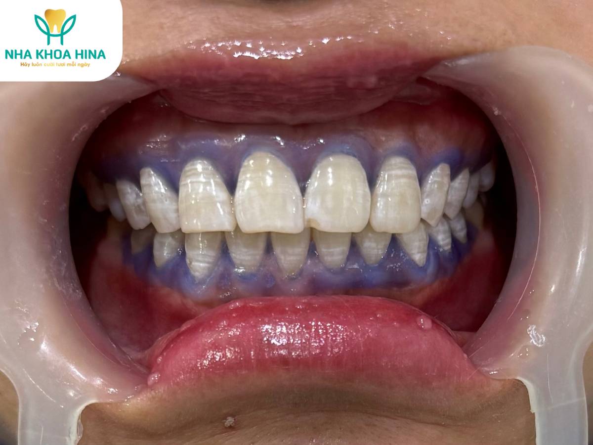 Tẩy Trắng Răng – Giải Pháp Cho Nụ Cười Tỏa Sáng