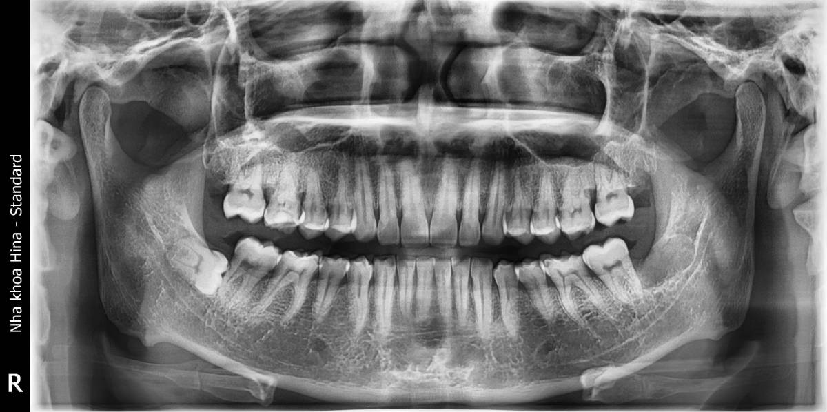 Răng khôn mọc nghiêng: Khi nào cần nhổ ngay?