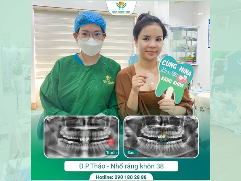 Mất ngủ vì đau răng khôn? Giải pháp hiệu quả tại Nha khoa Hina