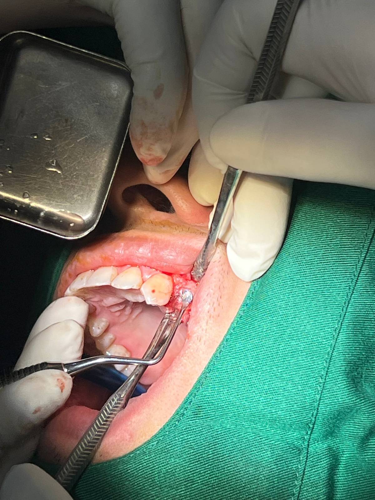 Trồng Răng Implant – Giải Pháp Hoàn Hảo Cho Răng Mất