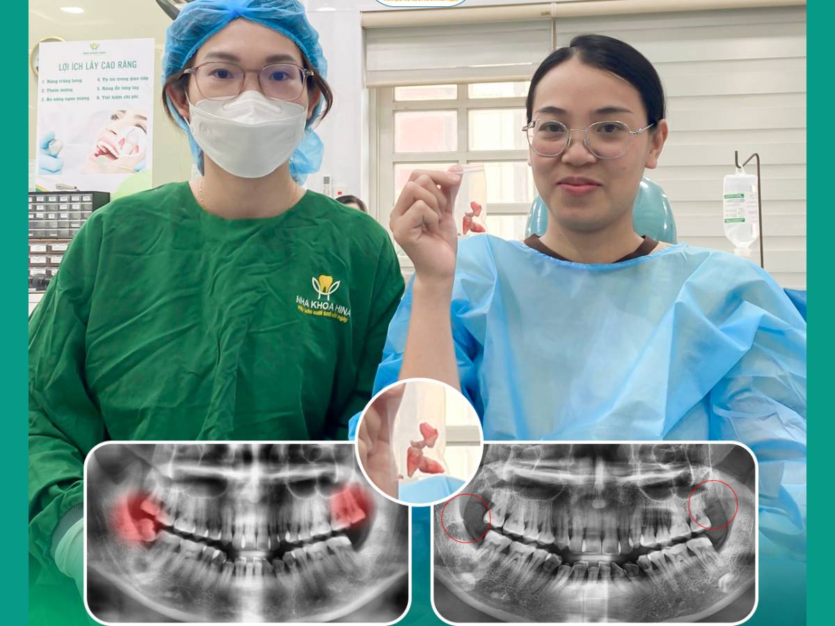 Nhổ răng khôn bằng công nghệ siêu âm tại Hina