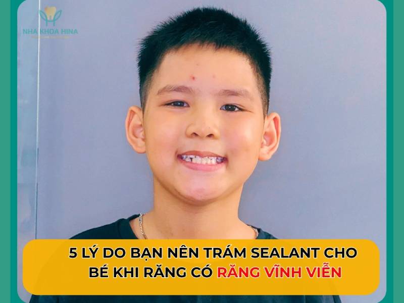 5 Lý do bạn nên trám Sealant cho bé ngay khi có răng vĩnh viễn