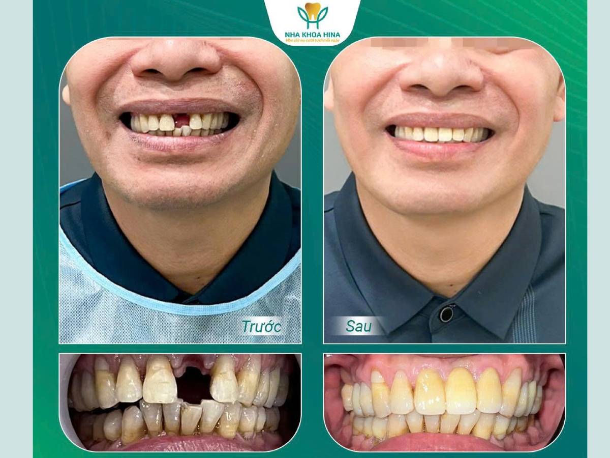 răng sứ toàn hàm