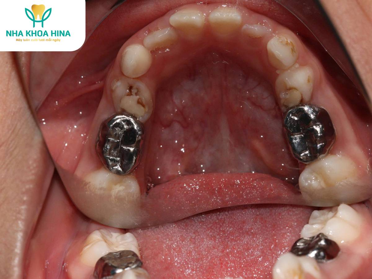 Chụp Thép – “Áo Giáp Bảo Vệ” Răng Sữa Cho Trẻ