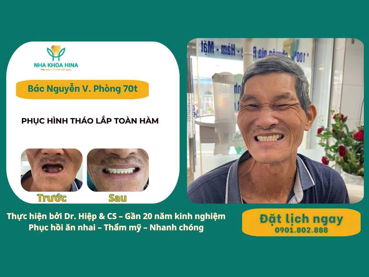 Phục hình tháo lắp toàn hàm