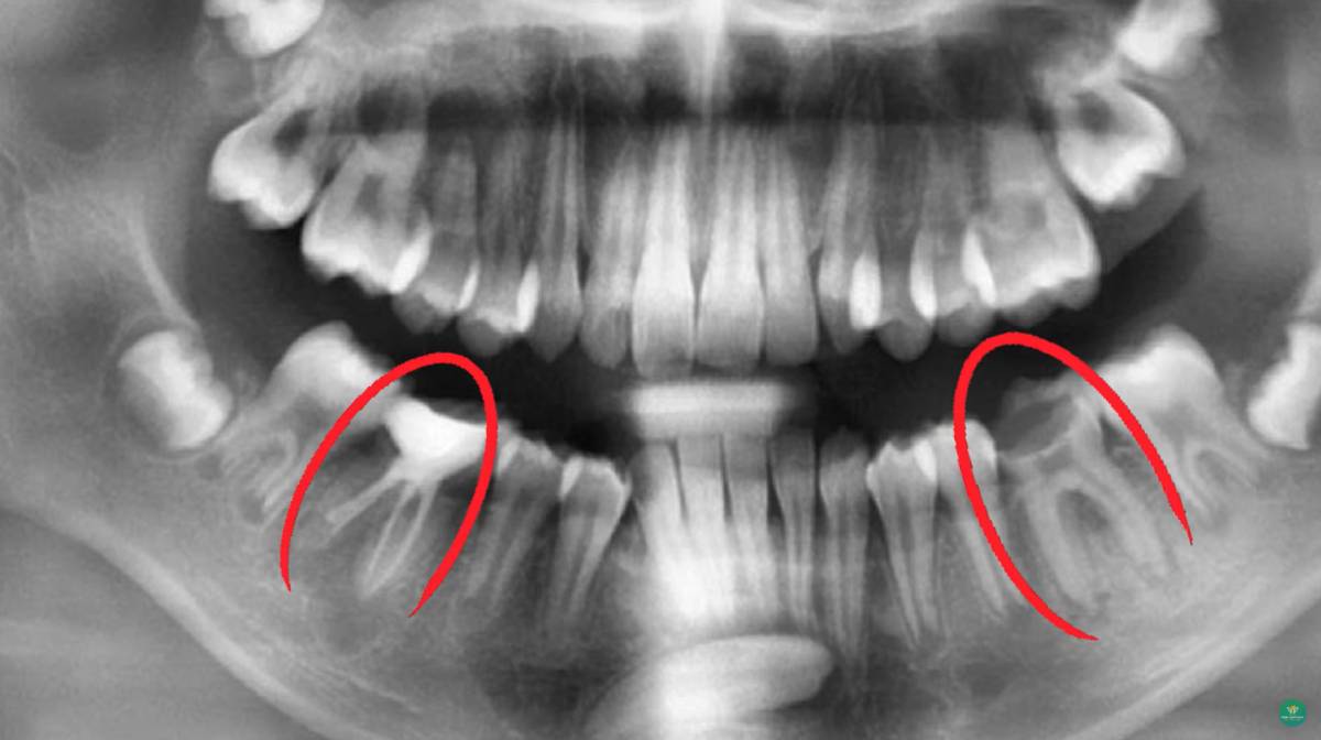 Nguy Cơ Hỏng Răng Vĩnh Viễn Và Sự Nguy Hiểm Của Răng Mọc Ngầm