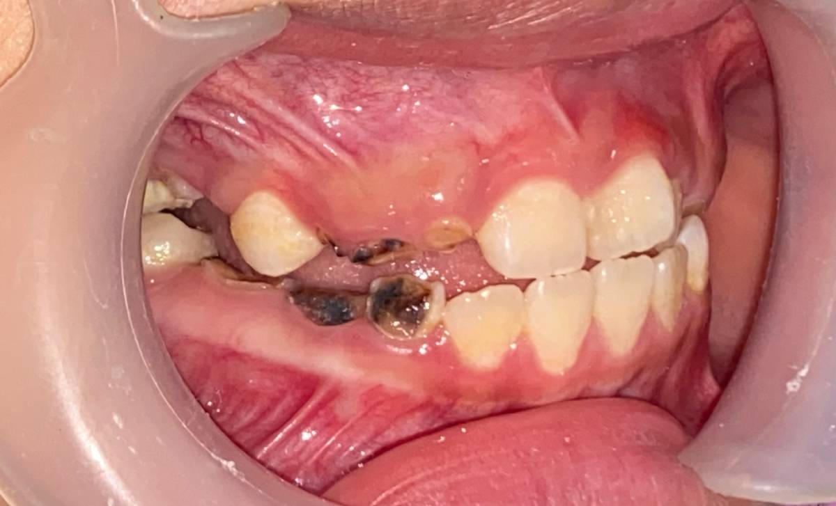 Các thói quen trẻ em cần tránh để răng vẫn khỏe mạnh từ nhỏ đến lớn