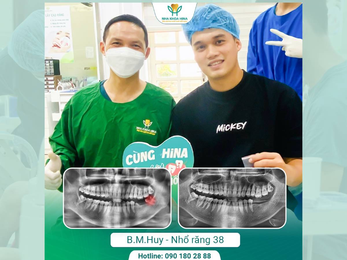 Những nguy cơ tiềm ẩn khi Răng khôn mọc lệch