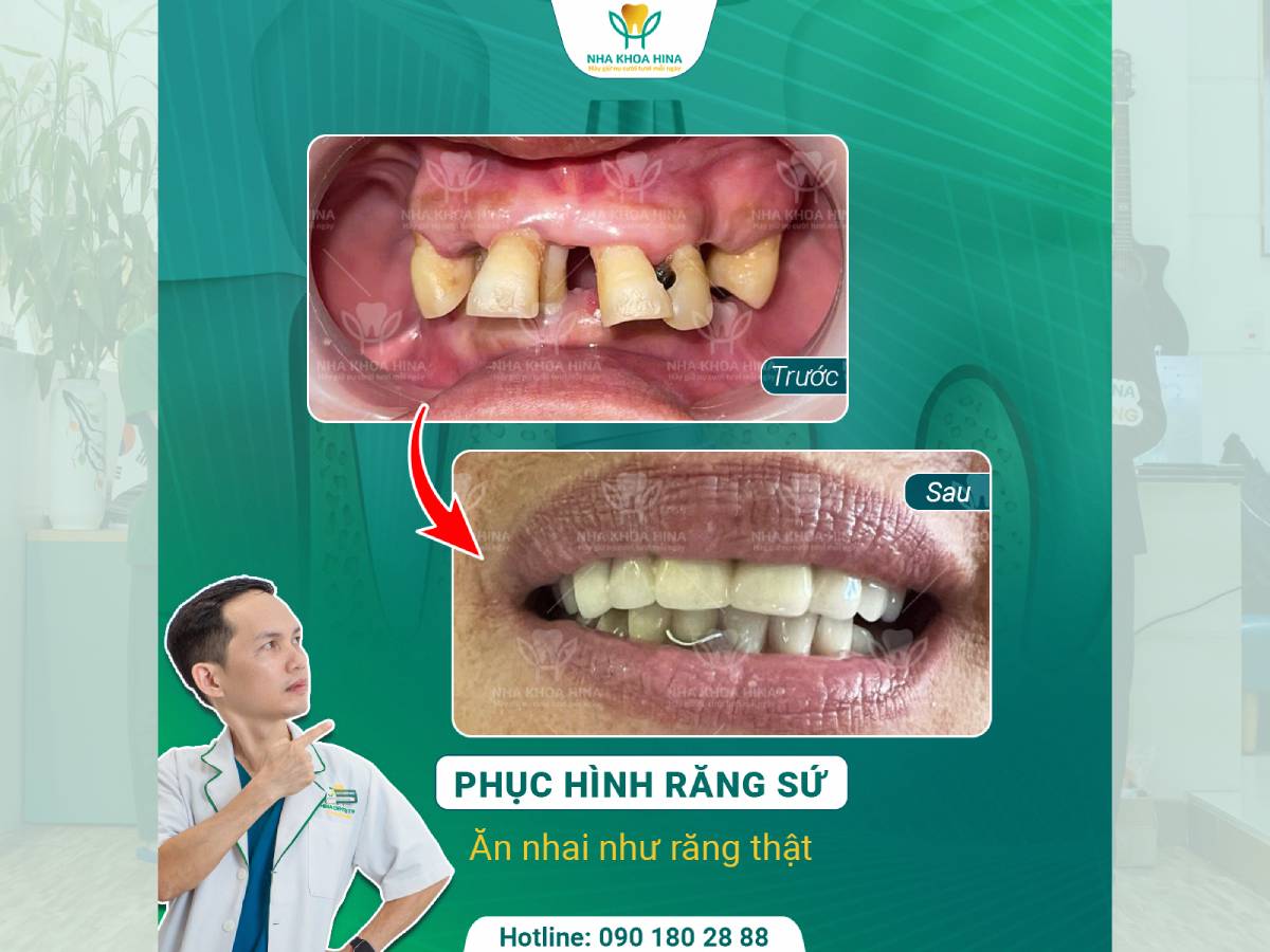 Phục Hình Răng Sứ – Ăn Nhai Vững Vàng, Tự Tin Nụ Cười