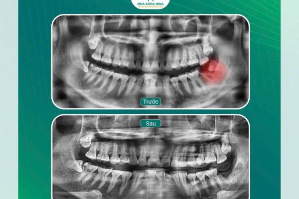 Nhổ răng khôn số r47, 48