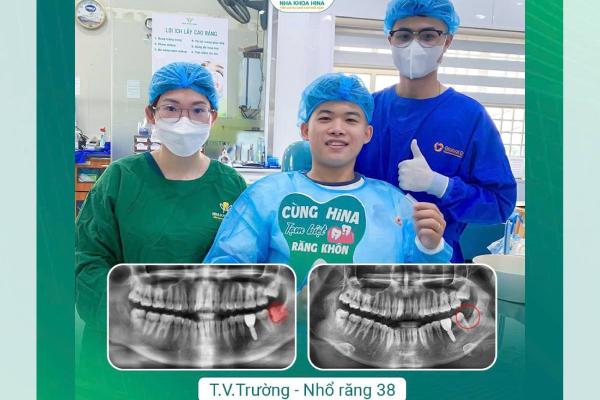 Nhổ răng khôn số 38 Nhổ răng khôn số 38