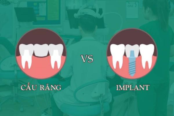 So sánh giữa trồng răng implant và cầu răng