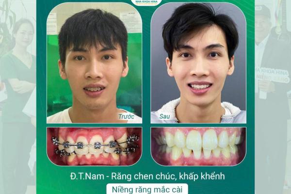 Niềng Răng – Giải Pháp Hoàn Hảo Cho Nụ Cười Tự Tin Và Sức Khỏe Răng Miệng Niềng Răng – Giải Pháp Hoàn Hảo Cho Nụ Cười Tự Tin Và Sức Khỏe Răng Miệng