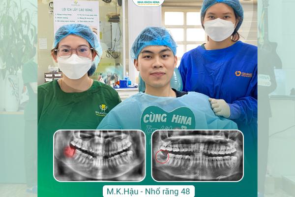 Chia Tay Răng Khôn – Bảo Vệ Răng Số 7 Tránh Nguy Cơ Hư Hại Chia Tay Răng Khôn – Bảo Vệ Răng Số 7 Tránh Nguy Cơ Hư Hại