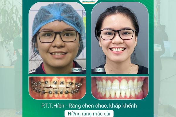 Niềng Răng – Tạm Biệt Tự Ti, Tự Tin Nụ Cười Rạng Rỡ Niềng Răng – Tạm Biệt Tự Ti, Tự Tin Nụ Cười Rạng Rỡ