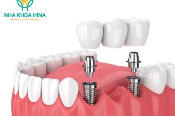 Trồng răng implant hãng nào tốt nhất?