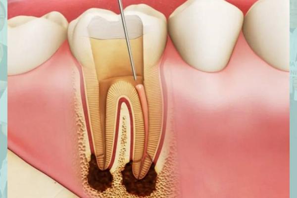 Viêm tuỷ răng - Biến chứng từ răng sâu không điều trị Viêm tuỷ răng - Biến chứng từ răng sâu không điều trị