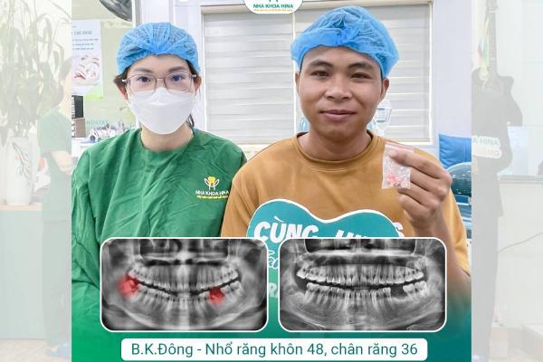 BÍ QUYẾT ĐỂ KHÔNG CÒN SỢ NHỔ RĂNG KHÔN: CHỌN ĐÚNG BÁC SĨ