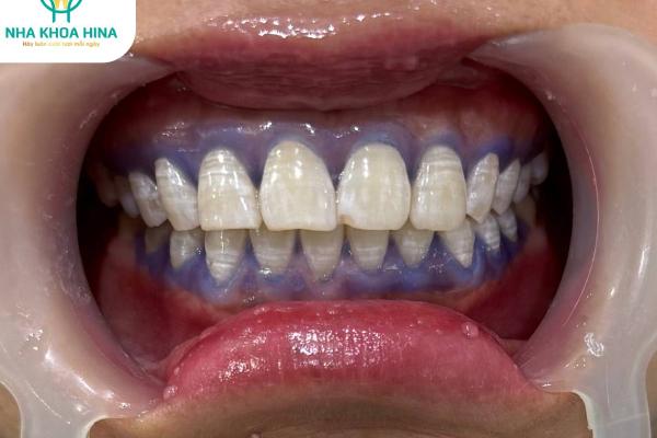 Tẩy Trắng Răng – Giải Pháp Cho Nụ Cười Tỏa Sáng Tẩy Trắng Răng – Giải Pháp Cho Nụ Cười Tỏa Sáng