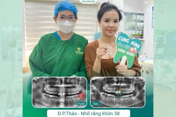 Mất ngủ vì đau răng khôn? Giải pháp hiệu quả tại Nha khoa Hina Mất ngủ vì đau răng khôn? Giải pháp hiệu quả tại Nha khoa Hina