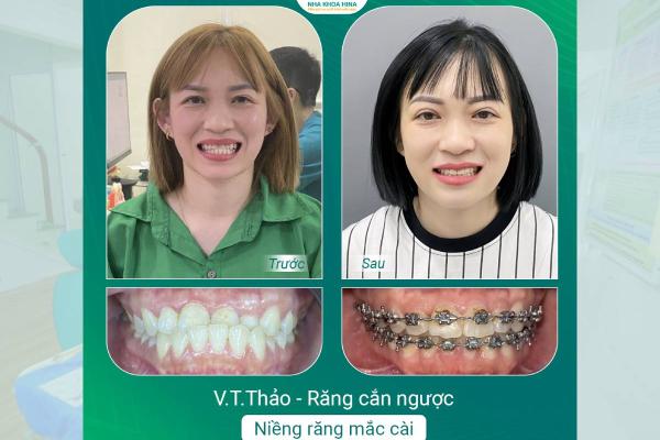 Niềng Răng Cắn Ngược – Không Chỉ Để Đẹp, Mà Để Bảo Vệ Khớp Cắn Niềng Răng Cắn Ngược – Không Chỉ Để Đẹp, Mà Để Bảo Vệ Khớp Cắn