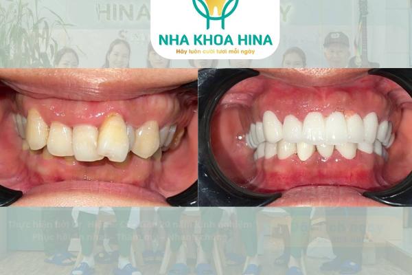 Răng Sứ Toàn Hàm – Giải Pháp Hoàn Hảo Cho Nụ Cười Toả Sáng