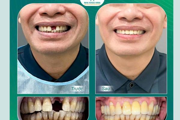 Răng sứ toàn hàm Răng sứ toàn hàm