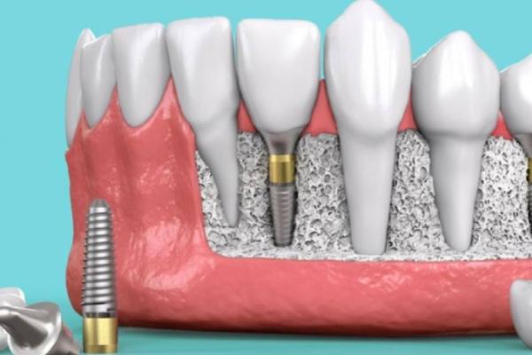 trồng răng Implant
