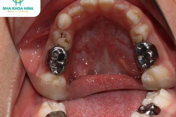 Chụp Thép – “Áo Giáp Bảo Vệ” Răng Sữa Cho Trẻ Chụp Thép – “Áo Giáp Bảo Vệ” Răng Sữa Cho Trẻ